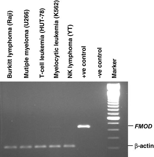Figure 2. Expression profile of fibromodulin mRNA of hematologic cell lines. Positive (+ve) controls represent PCR product cloned into pGEM-T easy vector, and negative (-ve) control is the reaction mix without template. Marker is a 100-bp DNA ladder.