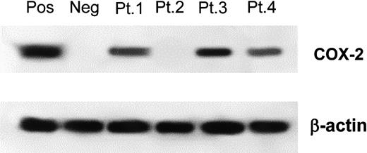 Figure 1. Western blotting for COX-2 expression. A representative example of COX-2 expression analysis on MM samples. Patient 1, patient 3, and patient 4 were scored COX-2 positive. Patient 2 was scored COX-2 negative. β-actin loading control is shown in both experiments. Pos, indicates positive control (HT-29 cell line); Neg, negative control (normal BM).