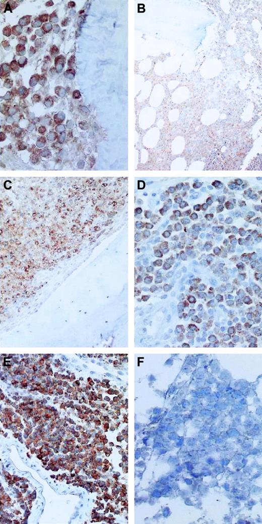 Figure 5. Immunohistochemistry in MM tissue sections. (A) Heterogeneous moderate and (B) homogeneous strong COX-2 expression in paravertebral-located extramedullary tumor. (B-C) Little or no COX-2 immunoreactivity in endothelial cells of small venules. (D-E) Larger clusters of plasma cells in BM samples; no significant immunoreactivity of osteoblasts and osteoclasts. (F) An example of COX-2 negativity on malignant plasma cells. This patient had massive bone marrow infiltration by malignant plasma cells that did not show COX-2 immunoreactivity. Original magnification: × 100 for panels A, B, D, E and × 200 for panels C and F. The microscope was an Axioskop (Zeiss, Germany) with Plam-Neofluar objective lens ×20, numerical aperture 10. Immersion oil was not used. The camera was a JVC model 3-CCT, and the acquisition software was Analysis Software (Softimaging Systems, Germany).