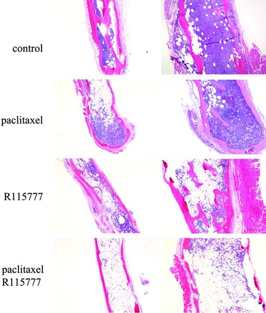 Figure 6. R115777 enhances paclitaxel antitumor activity in the SCID-hu bone mouse model of MM growth. SCID mice were implanted with human fetal bones injected with RPMI8226/S cells. After the tumors formed, the mice were treated with paclitaxel or R115777 or both for 2 weeks. The implanted bones were then analyzed by histology staining. Representative pictures from each group are shown.