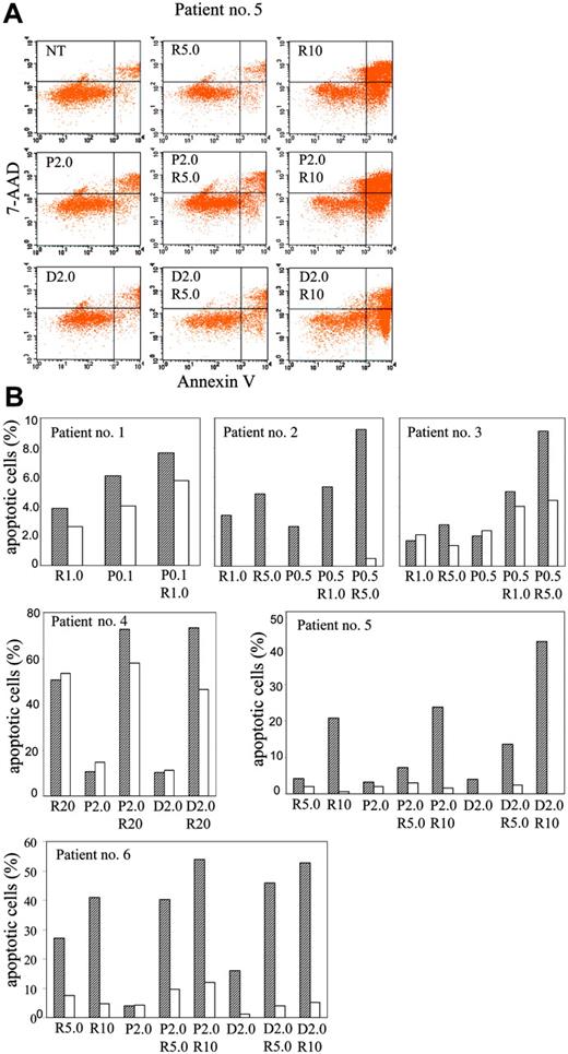 Figure 7. Combination of paclitaxel or docetaxel with R115777 is beneficial in the induction of apoptosis in MM patient bone marrow MNCs. MNCs were isolated from bone marrow aspirates and incubated with paclitaxel (P), docetaxel (D), and R115777 (R) at different concentrations (μM) for 48 to 72 hours. Cells were then stained with CD138-PE, annexin V-APC, and 7-AAD, and subjected to flow cytometric analysis as described in “Materials and methods.” Apoptosis in CD138+ and CD38- cells was then analyzed. (A) Dot graphs showing annexin-V staining profiles of cells from patient no. 5 treated with different drugs at different concentrations. CD138+ cells were gated for analysis. (B) Summary of annexing staining results of MNCs from 6 patients after treatment with different drugs at different concentrations. Net increases in apoptotic cells after subtracting the apoptotic cells in the untreated group from CD138+(▨) and CD138- (□) cells are shown.