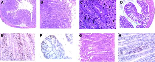 Figure 4. Colitis is characterized by extensive infiltration of T cells and granulocytes. (A) Histologic analysis of colitis in B6 Rag recipients that received B6→Balb GVHD T cells, revealing marked infiltration of mononuclear cells into the lamina propria accompanied by depletion of goblet cells and sloughing of the mucosa into the colonic lumen along with (B) transmural inflammation extending out into the mesentery indicative of serosal inflammation (original magnification, × 200). (C) Neutrophils (dashed arrows) and eosinophils (solid arrows) in regions of histologically damaged colonic tissue. (D) Colonic mucosa in Balb-Rag recipients showing no evidence of colitis with preservation of goblet cells and the absence of inflammation in the lamina propria and muscularis mucosa. (E) Immunohistochemical staining showing extensive CD3+ T-cell infiltration (brown staining cells) throughout the lamina propria extending across the wall of the colon into the surrounding mesentery corresponding to sites of tissue damage in B6 Rag animals (ie, crypt abscesses, crypt cell apoptosis). (F) Absence of GVHD T-cell infiltration into the mucosa or lamina propria of Balb Rag mice. (G) Colonic tissue from B6 Rag recipients of B6→B10.BR spleen cells showing similar pathologic damage and (H) CD3+ T-cell infiltration as in panels A and E, respectively.
