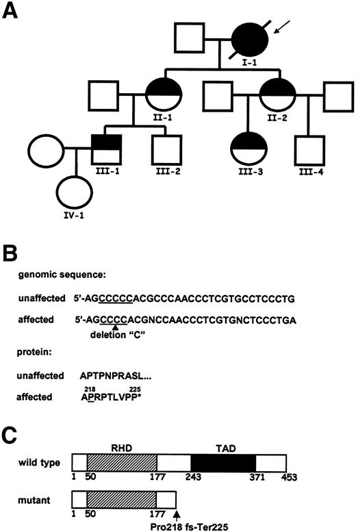 Figure 1. Family pedigree and sequence analysis of the AML1 gene. (A) The family pedigree is shown. Half-filled symbols indicate thrombocytopenia; the closed symbol, the individual who developed CMMoL; and open figures, unaffected family members. The index patient is indicated by the arrow. (B) Genomic and protein AML1 sequence in healthy and affected individuals. A single nucleotide deletion (arrowhead) within 5 consecutive C's generates a frameshift at amino acid position 218 (underlined) and premature chain termination (*). (C) Schematic representation of the wild-type and mutant truncated AML1 protein. The predicted protein includes an intact runt homology domain (RHD) (amino acids 50 to 177) but lacks a transactivation domain (TAD) (amino acids 243 to 371). The position of the Pro218fs-Ter225 mutation is indicated by the arrow.