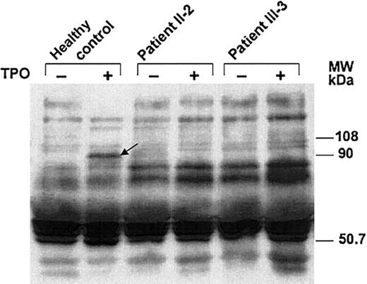 Figure 5. Induction of tyrosine phosphorylation of platelet proteins after stimulation with TPO. Platelets were unstimulated (-) or stimulated (+) with TPO, 100 ng/mL, followed by lysis and immunoblotting. Platelet proteins (35 μg) were loaded and separated on a 7.5% polyacrylamide gel. After protein transfer, membranes were incubated with an HRP-conjugated antiphosphotyrosine antibody followed by ECL detection. Stimulation of normal platelets (left lanes) with TPO led to phosphorylation of proteins of apparent molecular weight 95 kDa (arrow). Shown are the results of 2 affected family members (middle and right lanes) who fail to reveal TPO-mediated signaling. This experiment was performed in duplicate with similar results.