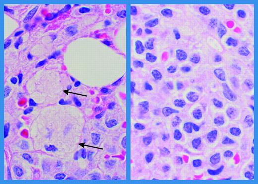 Bone marrow histology in a patient with Gaucher disease and multiple myeloma. Bone marrow biospsy obtained at the time of diagnosis of multiple myeloma in a 56-year-old male patient with Gaucher disease. (Left panel) Small areas containing Gaucher cells (arrows). (Right panel) Extensive infiltration with abnormal plasmacytoid lymphocytes and plasma cells (hematoxylin and eosin; original magnification ×1000; Olympus BH-2). Immunostaining was positive for CD38, immunoglobulin G, and lambda. Karyotyping revealed no chromosomal rearrangements. (Courtesy of Dr Margaret E. Rick, Hematology Service, Department of Laboratory Medicine, Clinical Center, National Institutes of Health, Bethesda, MD.)