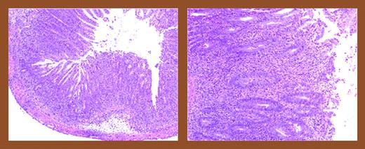 Colitis is characterized by extensive infiltration of T cells and granulocytes. See the complete figure in the article beginning on page 4885.