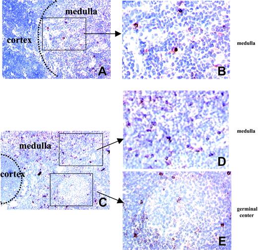 Figure 4. Distribution of CD25+ cells in normal and hyperplastic MG thymi. Frozen sections of normal (A-B) and hyperplastic MG (C-E) thymi were stained with anti-CD25 mAb (red color) and counterstained with Gill hematoxylin. The left photomicrographs (original magnification × 100) show that CD25 expression is observed in the medullary area of normal (A) and hyperplastic MG thymus (C-D) and, in addition, around the germinal centers of hyperplastic MG thymus (C,E). The right photomicrographs (original magnification × 400) are enlargements of the framed areas corresponding to medullary area of normal (B) and MG (D) thymus and germinal center of MG thymus (E).
