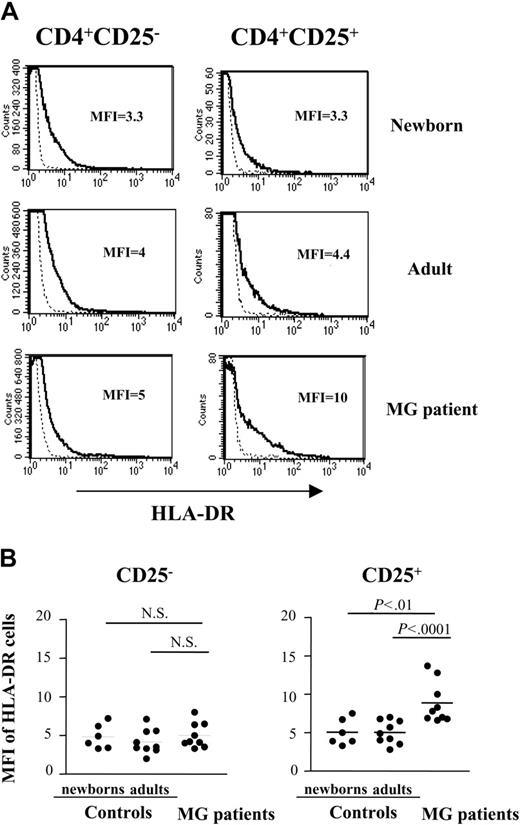 Figure 5. Expression of HLA-DR is increased in CD4+CD25+ T cells from patients with MG. (A) Representative HLA-DR expression profile for newborn, young adult, and myasthenic CD8-depleted thymocytes stained with anti-HLA-DR, anti-CD25, anti-CD4 mAbs and analyzed by flow cytometry. HLA-DR expression is shown with a solid line and the staining with an isotype IgG control with a dotted line. (B) The percentage of HLA-DR was determined among CD4+CD25- and CD4+CD25+ cells in 9 MG patient, 9 young adult and 6 newborn thymi. • represents 1 patient or 1 control. Bars indicate mean values.