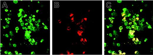 Figure 2. Circulating MMM CD41+ megakaryocytic cells expressed IL-8 protein. Smears of blood mononuclear cells from patients with MMM were subjected to double labeling with anti-CD41 and anti–IL-8. The 3 panels show the same field of cells (magnification × 200). (A) Green fluorescent staining of anti-CD41–FITC. (B) Red-orange fluorescence staining of anti–IL-8–PE. (C) Double labeling of IL-8 and CD41 antigens. Slides were observed with a fluorescence microscope (Leica DMR, 200 × aperture .30, 400 × aperture .50; Leica, Heidelberg, Germany).