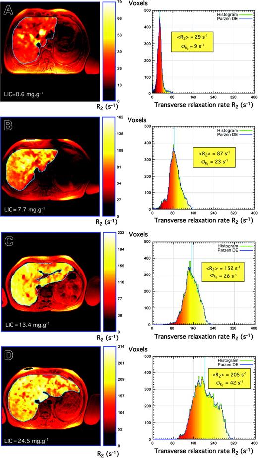 Figure 4. Liver R2 images and distributions. Liver R2 images and distributions for 4 subjects with different degrees of iron overload and pathologic conditions: (A) hepatitis, (B) HH, (C) β-thalassemia, and (D) β-thalassemia/hemoglobin E. Note that the liver R2 images are superimposed on standard spin-echo images for registration purposes. Principles of construction of R2 images and distributions are described elsewhere.44 Note that to enable visualization of the heterogeneity of R2 within each liver, the color scale within each liver is adjusted for each image such that zero corresponds to voxel R2 of zero, whereas the maximum of the color scale is scaled to the maximum R2 value within the liver.