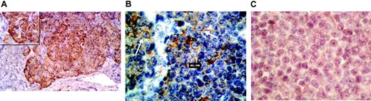 Figure 6. Immunohistochemistry for hCNT3 in pancreas tissue and lymph nodes from CLL patients. (A) Normal pancreas tissue showing the intense positive cytoplasmic staining for hCNT3 exhibited by pancreatic islet cells (original magnification × 25; inset × 40). (B) This CLL case shows pseudofollicles with prolymphocytes (white arrows) that were positive for hCNT3 immunostaining, whereas the small cell component (black open arrow) shows no immunostaining (original magnification × 40). (C) This CLL case again shows cytoplasmic staining in the scattered prolymphocytes, whereas small cells show detectable cytoplasmic immunostaining (original magnification × 40). Images were captured with a Nikon Eclipse E 680 microscope by Nikon View V3.0 software (Nikon, Melville, NY) using a Nikon 40 × lens with a 0.65 aperture.