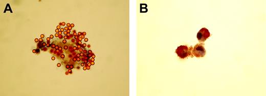 Figure 5. CECs and HUVECs express eNOS. (A) High-power (650×) light photomicrograph of an endothelial nitric oxide synthase–positive circulating endothelial cell from a patient with a recent acute myocardial infarction. Confirmation that the cell is endothelial is depicted by strong binding to CD146 coated magnetic beads (4μm in diameter). (B) “Positive control” photomicrograph (160×) of a cluster of 3 endothelial nitric oxide synthase–stained human umbilical vein endothelial cells. Note that staining is limited to the cytoplasm where most nitric oxide synthase is located. Images were visualized using an Axiostar Plus microscope (Zeiss, Welwyn Garden City, UK); objective lens, 40× and 10×; eyepiece, 10×. Images were captured using a Camedia C3030 camera, and transfered to JPG using standard smart card technology.