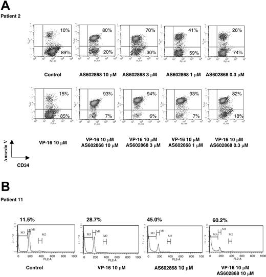 Figure 1. The IKK2 inhibitor AS602868 induces apoptosis of AML blasts. (A) Cells from patient 2 (36% CD34+ blasts) were incubated for 72 hours with indicated doses of AS602868 and VP16 before staining with anti-CD34-FITC antibody and annexin V-PE. Cells were gated on the CD34+ compartment. The percentages of apoptotic cells are displayed. (B) Sub-G1 analysis of apoptotic blasts. Blasts from patient 11 (more than 90% blasts) were stained with propidium iodide. The percentage of apoptotic blasts in sub-G1 (gate M3) is displayed.