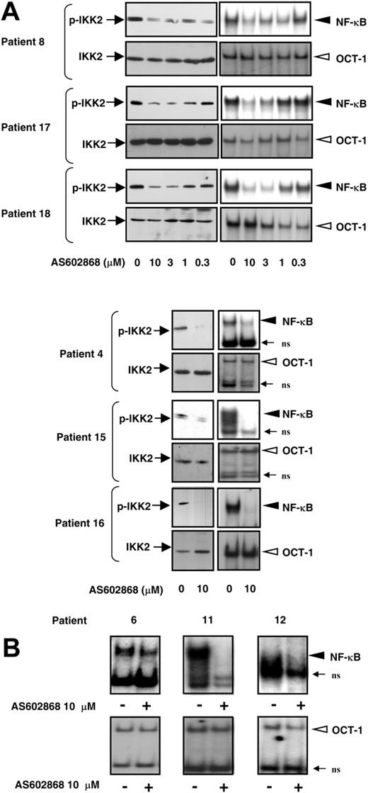 Figure 2. AS602868 inhibits constitutive activation of IKK2 and NF-κB in AML blasts. Blasts from patients 8, 17, and 18 were incubated with indicated doses of AS602868 for 18 hours. Blasts from patients 4, 6, 11, 12, 15, and 16 were incubated with 10 μM AS602868 for 18 hours or left untreated. (A, left column) AS602868 blocked autophosphorylation of IKK2 in AML blasts. Cell lysates were resolved by SDS-PAGE and transferred to Immobilon membranes. The autophosphorylation status of IKK2 was analyzed with antibodies against phosphorylated serines 177 and 181, and anti-IKK2 antibodies show equal amounts of the kinase in the different conditions. AS602868 inhibits NF-κB activation (Panel A, right column; and panel B). Total cell extracts were incubated with radioactive probes encompassing the NF-κB or OCT-1 DNA binding sequences. Complexes were separated by nondenaturing electrophoresis followed by autoradiography (EMSA). ns indicates nonspecific.