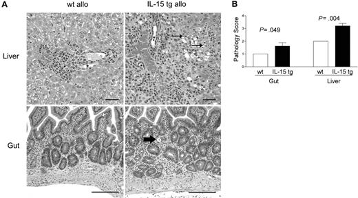 Figure 3. Deregulation of endogenous IL-15 increases cholangiohepatitis and enteritis in recipients of allogeneic bone marrow transplants. (A) Upper panel: Cholangiohepatitis in animals with acute GVHD. Mononuclear inflammatory cells surround bile ducts (asterisks). Lesions shown in a liver harvested from a recipient of IL-15 tg B6 allogeneic BM cells (IL-15 tg allo) are more severe than those shown in a liver from a recipient of wt B6 allogeneic BM cells (wt allo) and include areas of hepatocyte necrosis (arrows). Bar = 50 μm. Lower panel: enteritis in animals with acute GVHD. There is a mononuclear inflammatory cell infiltrate in the lamina propria; crypts are hyperplastic and contain numerous mitotic figures. The intestine harvested from a recipient of IL-15 tg B6 allogeneic BM cells has more severe lesions than that harvested from a recipient of wt B6 allogeneic BM cells, including an area of crypt necrosis (arrow). Bar = 100 μm. Images were visualized using an Olympus BX41 microscope equipped with an Olympus 3040 camera and a Plan 20 × objective with an aperture of 0.40 (Olympus America, Melville, NY). The image medium was air, and the acquisition software was Adobe Photoshop (Adobe Systems, San Jose, CA). (B) Coded slides were scored by a veterinary pathologist in a blinded fashion as described in “Materials and methods.” Mice receiving IL-15 tg B6 allogeneic BM cells (solid bars) had significantly worse GVHD histopathology in the gut (P = .049) and liver (P = .004) compared with recipients of wt B6 allogeneic BM cells. Results are representative of 2 independent experiments involving a total of 12 mice.