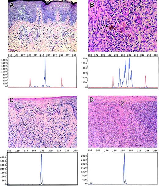 Figure 1. Correlation of TCR-γ PCR results and histologic evaluation in skin and corresponding lymph node. (A) This panel represents the skin lesion (MF) and (B) the dermatopathic lymph node of the same patient (no. 5) together with the corresponding PCR results after Genescan analysis. Whereas the skin lesion displays a clear clonal T-cell population (223 base pairs; bp), no clonally rearranged T cells were found in the dermatopathic lymph node (→ macrophages containing melanin). (C-D) These panels demonstrate the histology and PCR results (Genescan analysis) obtained from the skin (MF with typical Pautrier microabscess; C) and effaced lymph node (D) of patient no. 35. In contrast to patient no. 5, the same clonal T-cell population was detectable in both lesions (C and D, 200 bp). A,C: × 200. B,D: × 100.