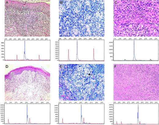 Figure 2. Correlation of TCR-γ PCR results in skin and dermatopathic and effaced lymph nodes. (A-C) Resembles skin and lymph node results of patient no. 7 and (D-F) of patient no. 12, respectively (A,D: skin; B,E: dermatopathic lymph node; C,F: effaced lymph node). Panels A and D show the typical MF histology with epidermotropic atypical lymphocytes present in the skin (with additional Pautrier abscess) in conjunction with the corresponding clonal T-cell populations as demonstrated by TCR-γ PCR and Genescan analysis. The same clonal T-cell populations were also found in the dermatopathic (B and E, → macrophages containing melanin) and effaced lymph node (C, F). Panels A to C (no. 7) revealed an identical peak size of 217 bp, and panels D to F (no. 12) revealed an identical peak size of 195 bp. A,D: × 200. B,C,E,F: × 100.