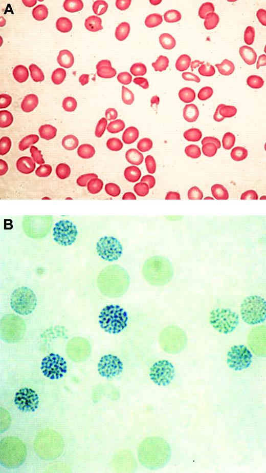 Figure 2. Typical blood findings in ATMDS. (A) Peripheral blood smear (May-Grünwald-Giemsa) from a patient with ATMDS who had not undergone transfusion. Many red blood cells are hypochromic or microcytic, but others appear relatively normal and well preserved, presumably the descendants of nonthalassemic clones. (B) Classic hemoglobin H (HbH) inclusions in a patient with ATMDS seen after supravital staining (brilliant cresyl blue). Images were visualized under a Zeiss upright optical microscope with Trinoc ocular unit (Carl Zeiss GmbH, Oberkochen, Germany) equipped with Zeiss 10 × ocular lenses and an Olympus C3000Zoom CCD 3.3 megapixel digital camera on a C-style mount (Olympus UK, Middlesex, United Kingdom). Digital images were transferred to an 800 MHz iBook computer with 12-inch video screen running OS 10.3.2 and iPhoto (Apple Computers, Cupertino, CA) and were processed with Adobe Photoshop 7.0 (Adobe Systems, San Jose, CA). Processing involved adjustments in image contrast, hue, and conversion from RGB to CMYK colorspace only; no other alterations were made. Figure 2A was viewed without a coverslip or immersion oil at 400 × total magnification, obtained using the ocular described above along with a Zeiss Plan 40 ×/0.75 objective lens. Figure 2B was viewed without a coverslip at 1000 × total magnification under a Zeiss Ph3 100 ×/1.25 oil immersion objective lens.