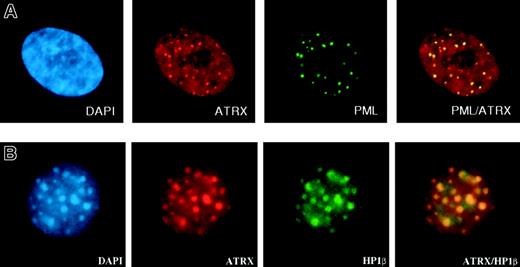 Figure 5. Immunofluorescence results. (A) ATRX localizes to subnuclear PML bodies (in human fibroblasts). Reprinted with permission from Xue et al.76 (B) ATRX colocalizes with HP1β at heterochromatin (in murine L929 cells). Courtesy Drs D. Garrick and T.L. McDowell; used with permission. Images were captured with a Sensys CCD camera (Photometrics, Tucson, AZ) mounted on an Olympus BX51 microscope (Olympus) equipped with an Olympus UPlanApo 100 ×/1.35 oil immersion objective lens. Coverslips were mounted in Vectashield (Vector Laboratories, Peterborough, UK) containing 0.5 μg/mL DAPI. Images were acquired with MacProbe version 4.3 software (Applied Imaging, Newcastle, UK) and processed with Adobe Photoshop 7.0 (Adobe Systems).