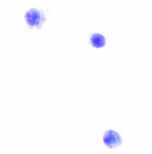 Burkitt's lymphoma in the cerebrospinal fluid.