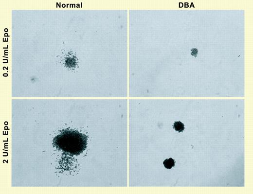 DBA colonies are smaller than normal at low or high erythropoietin concentrations. Mononuclear cells were cultured in liquid in phase I without erythropoietin, and in semisolid clonogenic culture in phase II. While the numbers of colonies from DBA patients were the same as from normal individuals, the DBA colonies were much smaller, since they contained fewer cells. See the complete figure in the article beginning on page 838.