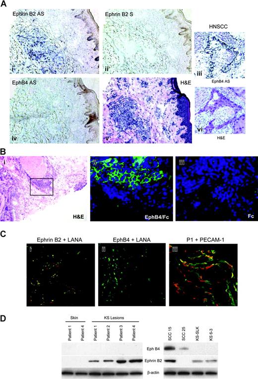 Figure 1. Ephrin B2 but not EphB4 is expressed in KS biopsy tissue. (A) ISH with antisense probes for ephrin B2 and EphB4 with corresponding H&E-stained section to show tumor architecture. Dark blue color in the ISH indicates positive reaction for ephrin B2. No signal for EphB4 was detected in the KS biopsy. For contrast, ISH signal for EphB4 is strong in HNSCC tumor cells. Ephrin B2 was also detected in KS using EphB4-alkaline phosphatase (AP) fusion protein (iv). AS indicates antisense; S, sense. (B) Detection of ephrin B2 with EphB4/Fc fusion protein. Adjacent sections were stained with H&E (i) to show tumor architecture; the black rectangle indicates the area shown in the EphB4/Fc-treated section (ii) detected with FITC-labeled anti-human Fc antibody as described in “Patients, materials, and methods.” As a control, an adjacent section was treated with human Fc fragment (iii). Specific signal arising from EphB4/Fc binding to the section is seen only in areas of tumor cells. (C) Coexpression of ephrin B2 and the HHV-8 latency protein LANA1. (i-ii) Double-label confocal immunofluorescence microscopy with antibodies to ephrin B2 (red), LANA1 (green), or EphB4 (red) of frozen KS biopsy material directly demonstrates coexpression of LANA1 and ephrin B2 in KS biopsy. Coexpression is seen as yellow color. (iii) Double-label confocal image of biopsy with antibodies to PECAM-1 (green) in cells with nuclear propidium iodide stain (red), demonstrating the vascular nature of the tumor. (D) Western blot of protein extracts of KS biopsies, normal skin, and cell lines. Membranes were sequentially probed with ephrin B2, EphB4, and β-actin monoclonal antibodies. Specific bands were detected at 120 kDa for EphB4, 37 kDa for ephrin B2, and 40 kDa for β-actin. Oral squamous cell carcinoma cell lines SCC-15 an SCC-25 are included as positive controls for EphB4 probing. Membranes were probed with β-actin as a control for loading and transfer of protein.