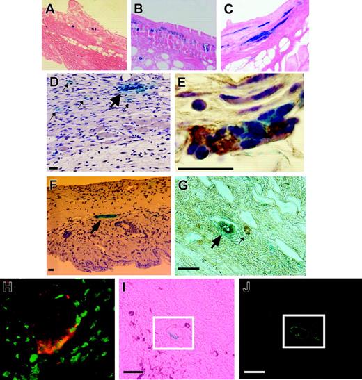 Figure 6. Coalescence of lacZ+ EPCs into functional blood vessels. (A) A histologic view of recruitment of lacZ+ bone marrow–derived EPCs to ischemic tissue starting as early as day 3 after surgery. (B) LacZ+ cells in the tissue at day 7 were either individual foci or cellular clusters, but did not appear as vascular structures and were not associated with vessels by CD31 staining. (C) By day 14, lacZ+ EPCs began to form a number of vascular-like structures. (D) Magnified histologic section at day 7 demonstrating the presence of both EPC clusters (thick arrow) and individual foci of EPCs (thin arrows). (E) Costaining of tie2/lacZ+ cell clusters with VWF confirmed the endothelial phenotype of lacZ-expressing cells in the tissue. (F) Day-14 histologic section demonstrating a fully formed bone marrow–derived lacZ+ blood vessel seen in cross-section. (G) Costaining of a tie2/lacZ+ vascular structure with VWF not only confirming the endothelial phenotype of lacZ-expressing blood vessels in the day-14 graft but clearly demonstrating 2 distinct blood vessels: on the left (thick arrow), a vessel composed entirely of EPCs (in blue), and on the right (thin arrow), a vessel that is not derived from EPCs. (H) Identification of EPCs and endothelial cells with antibodies against CD31 and β-gal, respectively, yielded similar findings, as shown in a high-power view of cells costaining for CD31+ (green) and β-gal (red). (I) (J) Colocalization of tie2/lacZ+ structures with the in vivo FITC-lectin stain, seen histologically and under fluorescent microscope, show perfusing vessels at day 14. Scale bar = 20 μm.