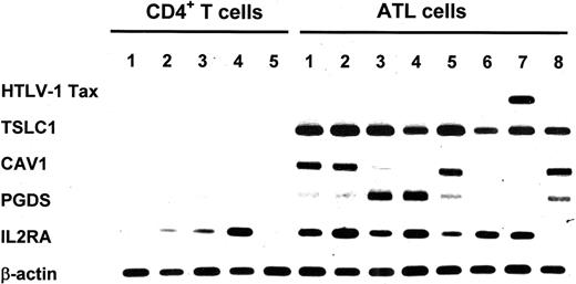 Figure 1. Semiquantitative PCR of 6 genes in primary ATL cells and control CD4+ T cells. Expression of up-regulated genes in the ATL cells was detected by DNA microarray analysis and confirmed by semiquantitative RT-PCR. cDNA prepared from total RNA of 8 primary ATL cells and 5 CD4+ T cells was amplified by PCR with the specific primer sets listed in “Patients, materials, and methods.” The expression of HTLV-1 Tax and IL2RA was also determined by RT-PCR. The expression level of β-actin is shown at the bottom of the figure as a control.
