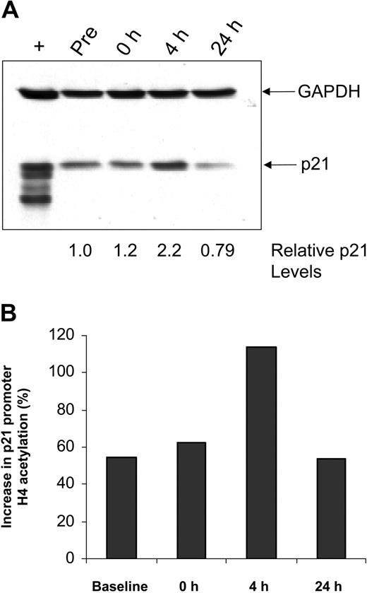 Figure 2. Effects of depsipeptide on p21 in vivo. (A) Lysates from CLL patient cells obtained before and 4 or 24 hours after depsipeptide administration were analyzed by immunoblot using an anti-p21 antibody. Simultaneous incubation with anti-GAPDH antibody was performed to detect protein-loading differences. (B) Cells from these same time points were subjected to chromatin immunoprecipitation analysis using anti-acetylated H4 antibody. The graph shows the increase in p21 promoter acetylation relative to GAPDH.