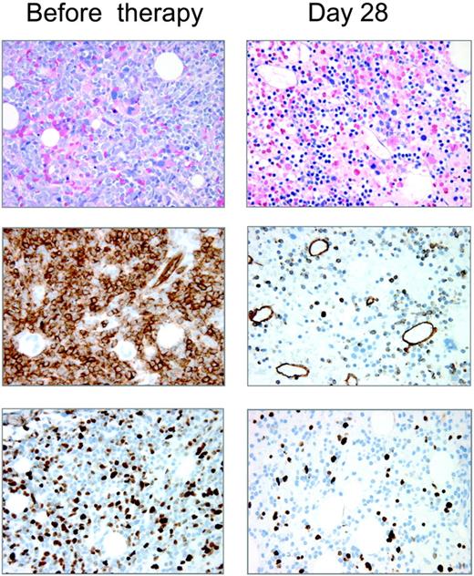 Figure 5. Bone marrow histology of patient no. 13. Bone marrow biopsies of patient no. 13 (FLT3-ITD) taken pretreatment and on day 28 of cycle 1 were stained with Wright-Giemsa, CD34, and Ki-67 (magnification × 400).