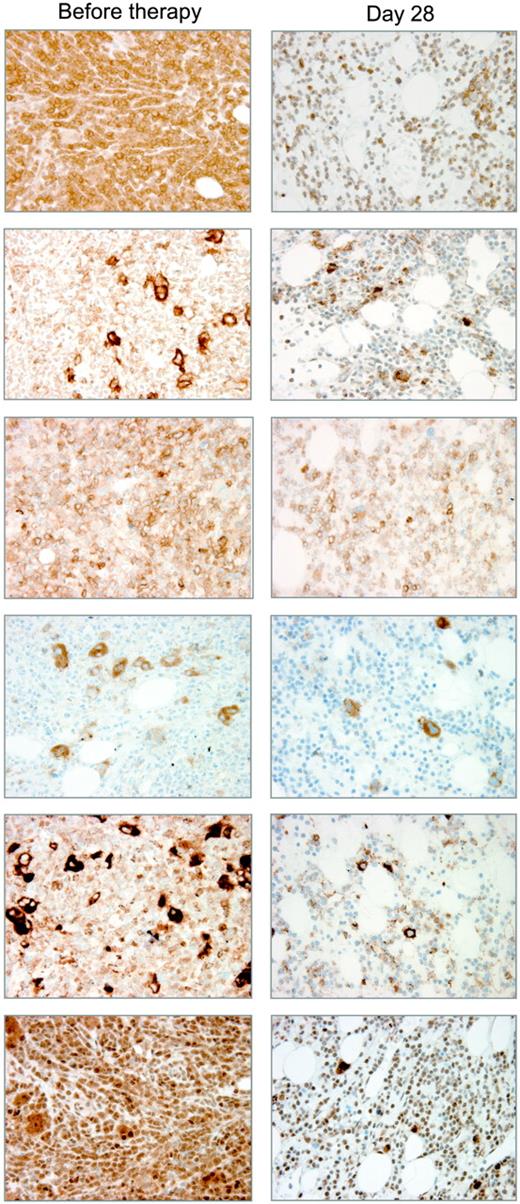 Figure 6. Immunohistology of bone marrow biopsies of patient no. 13. Immunohistochemistry of bone marrow biopsies of patient 13 collected before therapy and on day 28 of first cycle. The bone marrow sections were stained for total and phosphorylated forms of VEGFR-2, c-kit, and the phosphorylated forms of the signal transduction intermediates STAT5 and Akt (magnification × 400).