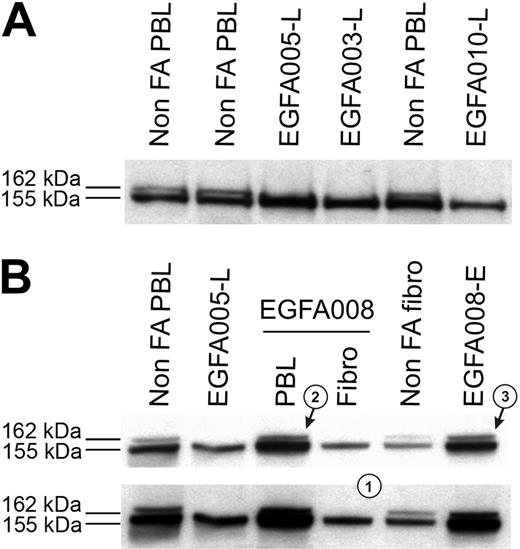 Figure 1. FANCD2 immunoblot patterns in FA patients, including FA revertant. (A) FA core samples failed to monoubiquitinate FANCD2 and show only the lower unmodified short (FANCD2-S) isoform, whereas non-FA samples show both the FANCD2-S and the long monoubiquitinated (FANCD2-L) isoforms. FA patients are referred to by unique EGFA identification numbers. (B) Detection of FA reversion by the FANCD2 pattern analysis. Revertant patient EGFA008 samples show typical FA in primary fibroblasts pattern (a single FANCD2-L isoform, indicated as 1), whereas fresh PHA-stimulated lymphocytes (arrow 2) and the EBV-immortalized B-cell line (arrow 3) show both the FANCD2-S and FANCD2-L isoforms. Normal and nonrevertant EGFA005 are shown as controls. Short (top panel) and medium (bottom panel) exposures are shown.