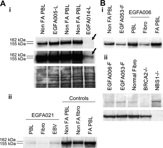 Figure 3. Analysis of FA-D2 and unidentified downstream group FA cells. (A) FANCD2 immunoblots detect the FA-D2 group. (i) No FANCD2 protein was observed at normal exposure of the immunoblot in sample EGFA014-L (top arrow). Long exposure revealed 2 barely detectable FANCD2 bands (bottom arrow), indicating residual levels of the FANCD2 protein, as previously shown in the reference D2 cell line PD20.6,10 Ponceau S staining is shown as loading control. Sequencing data further confirmed mutations in the FANCD2 gene in this patient (A.S., data not shown). (ii) FANCD2 immunoblot of PHA-stimulated primary fibroblasts and EBV-immortalized cells from FA-D2 patient EGFA021. (B, i) Unidentified group patients EGFA006 and EGFA053 have normal FANCD2 patterns in both their primary fibroblasts and lymphocytes (EGFA053-L; not shown). (ii) BRCA2 and NBS1 immunoblots detected no abnormalities in the fibroblasts of these 2 patients. EUFA243 and EUFA1020 EBV cell lines were used as positive controls for BRCA2 and NBS1 deficiency, as indicated.