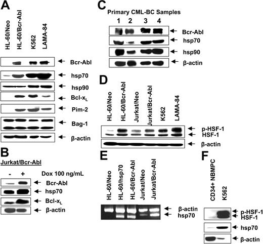 Figure 1. Bcr-Abl expression is associated with higher expression of hsp70 in human leukemia cells. (A) Western analyses of Bcr-Abl, hsp70, hsp90, Bcl-xL, Pim-2, Bag-1, and Bcl-2 in cell lines with expression of Bcr-Abl (K562, LAMA-84, Jurkat/Bcr-abl, HL-60/Bcr-Abl) and cell lines without expression of Bcr-Abl (HL-60/Neo, Jurkat). β-actin levels were used as the loading control. (B) Western analyses of Bcr-Abl, hsp70, and Bcl-xL in Jurkat/Bcr-Abl cells with doxycycline-inducible expression of Bcr-Abl. β-actin levels were used as the loading control. (C) Protein expression of Bcr-Abl, hsp70, and hsp90 in four samples of primary CML-BC leukemia cells. Cell lysates were immunoblotted with anti–Bcr-Abl, hsp70, and hsp90 antibodies. β-actin levels were used as loading control. (D) Western analysis of the heat shock factor-1 (HSF-1) and p-HSF-1 in cell lines with expression of Bcr-Abl (K562, LAMA-84, Jurkat/Bcr-abl, HL-60/Bcr-Abl) and without expression of Bcr-Abl (HL-60Neo, Jurkat/Neo). β-actin levels serve as the loading control. (E) RT-PCR analysis of mRNA expression of hsp70 in HL-60/Neo, HL-60/hsp70 (with ectopic overexpression of hsp70), Jurkat/Neo Jurkat/Bcr-abl, and HL-60/Bcr-Abl cells.β-actin mRNA served as the control. (F) Western analysis of p-HSF-1, HSF-1, and hsp70 performed on the cell lysates obtained from a representative sample of primary normal bone marrow progenitor cells (NBMPCs). β-actin levels were used as a loading control.
