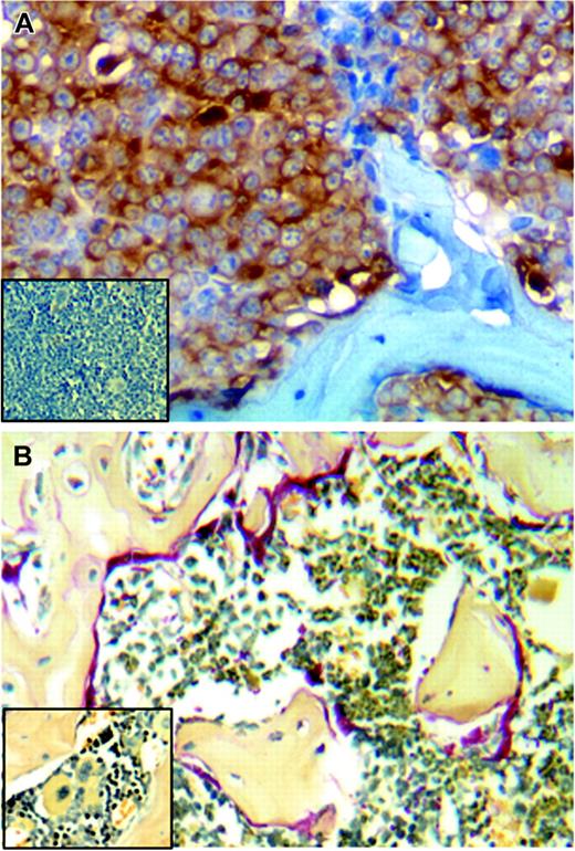 Figure 3. Tumors formed by heparanase-transfected cells metastasize to bone and enhance osteoclastogenesis. (A) Immunostaining for human kappa light chain (brown) detects CAG tumor cells present in the femur of an animal injected subcutaneously with heparanase-transfected cells. (Inset) Cells stained for kappa light chain are not detected in the femur taken from a mouse injected subcutaneously with the control-transfected CAG cells. (B) Extensive osteoclast activity is detected by TRAP staining (red) in femurs where heparanase-transfected CAG cells have metastasized. (Inset) Little osteoclast activity is detected in control animals that lack bone metastases. (Original magnification, × 200.)