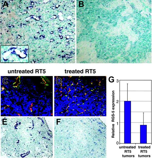 Figure 6. RGS-5 expression correlates with the degree of vascular remodeling in hypoxia-responsive and nonresponsive astrocytomas. (A) WT-AST (original magnification × 10; insert, original magnification × 25) and (B) HIFko-AST (original magnification × 10) were probed with a RGS-5–specific antisense riboprobe to demonstrate differential RGS-5 expression in the tumor vasculature. (C) Tumor samples from untreated 26-week-old RIP1-Tag5 mice with a hemorrhagic “red” appearance and enlarged tumor vessels were stained with anti-CD31 (red) and antidesmin (green) antibodies and the merge is shown (original magnification × 16). (D) Littermates were irradiated with 1000 rad, followed by bone marrow reconstitution and 3 adoptive transfers. At 26 weeks of age, “white” tumors were isolated, which display capillary-like vessels with no signs of hemorrhaging. Costaining for CD31 (red) and desmin (green) is shown (original magnification × 16). Differential expression of RGS-5, assessed by in situ hybridization, is shown for untreated tumors (E) and for regressing tumors after therapy (F). Original magnifications × 16 (E-F). (G) Histologic analyses were complemented by quantitative RT-PCR. Expression levels were normalized to HPRT.