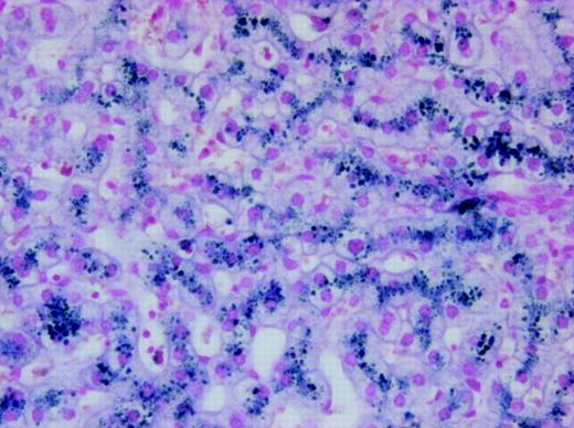 Figure 1. Photomicrograph of liver biopsy from the patient showing iron deposition in both hepatocytes and Kupffer cells. Staining technique: Perl Prussian blue stain. Original magnification, × 200. The image was acquired using an Olympus BX50 microscope equipped with a UPlan F1 × 20/0.5 NA objective. The photography was performed using an Olympus DP50 digital camera and the Viewfinder Lite version 1.0 program (Pixera, Los Gatos, CA).