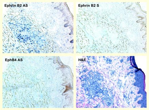 Ephrin B2 but not EphB4 is expressed in KS biopsy tissue. See the complete figure in the article beginning on page 1310.