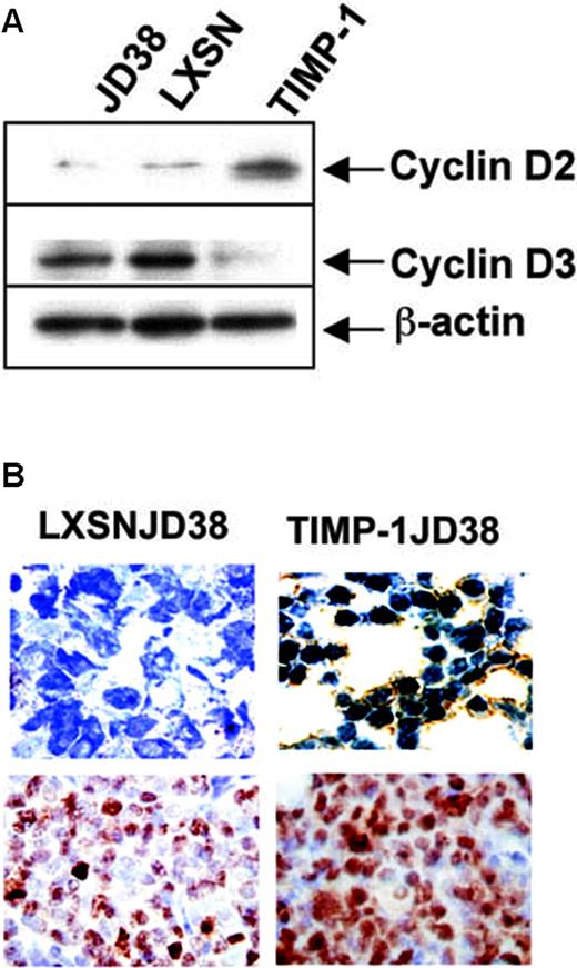 Figure 4. TIMP-1 effect in cell proliferation and cell cycle regulators. (A) Western blots demonstrating a switch in cyclin D usage; TIMP-1 up-regulates cyclin D2 and down-regulates cyclin D3 in TIMP-1JD38. β-actin was included as a control for equal protein loading. (B) Immunochemistry of TIMP-1JD38 tumor sections demonstrates differential expression of TIMP-1 (top row) in the cytoplasm and a higher intensity in the immediate cytoplasm membrane perimeter; original magnification × 1000. Aberrant TIMP-1 expression does not affect tumor cell proliferation. Both control LXSN-JD38 and TIMP-1JD38 tumors show equal expression of the cell proliferation marker Ki-67 (bottom row); original magnification × 1000. Sections were examined under an Olympus BX41 microscope using UPLAN F1 40 ×/0.75 objective lenses. DAB shows specific staining in brown. Digital images were obtained with an Olympus DP12 (Olympus, Melville, NY) and imported with an Olympus Camedia USB Smartmedia card into AdobePhotoshop 7.0 (Adobe Systems, San Jose, CA) for processing.