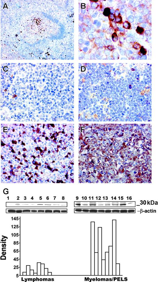 Figure 5. Correlation of TIMP-1 expression with plasmacytic phenotype. Immunohistochemistry of a normal reactive follicle demonstrates expression of TIMP-1+ cells in the light zone (A); original magnification × 100. Detailed TIMP-1 expression in the cytoplasm of differentiated B cells in the light zone (B); original magnification × 1000. Expression of TIMP-1 in primary tumors. Follicular-center lymphoma (C) and a Burkitt lymphoma (D) do not express TIMP-1; bona fide normal plasma cells are positive in these tumors. Myeloma cases (E-F) demonstrate TIMP-1 overexpression by the majority of tumor cells, with higher expression in panel F and lower TIMP-1 expression in panel E; original magnification × 400. (Image acquisition procedures described in Figure 4 apply.) (G) Western blots demonstrate TIMP-1 (30 kD) expression in different lymphoma cell lines. The y-axis of the graph shows relative density of TIMP-1 versus β-actin bands. A significant difference is noted between the lymphoma cell line group and the cell line group of myelomas and primary effusion lymphomas (PELs; P < .005). Mantle cell lymphomas: NCEB, Granta (lanes 1 and 2); follicular lymphomas: SUDHL-4, SUDHL-5, SUDHL-6 (lanes 3-5); Burkitt lymphomas: Ramos, JD38, BL-41 (lanes 6-8); multiple myelomas: KMM-1, KMS-11, KMS-12BM, JIM-3, OPM-2 and PEL: BC-2, BC-3 (lanes 10-16); MCF-7 breast carcinoma positive control (lane 9).