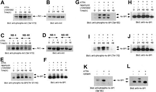 Figure 7. RA-dependent phosphorylation/activation of the Akt-kinase and phosphorylation of the 4E-BP1 repressor of mRNA translation. (A) NB-4 cells were incubated with RA for the indicated times. Two and a half hours prior to cell lysis, LY294002 was added to the cultures, as indicated. The cells were subsequently lysed and equal amounts of total cell lysates were resolved by SDS-PAGE and immunoblotted with an antibody against the phosphorylated form of Akt on serine 473. (B) The blot shown in panel A was stripped and reprobed with an anti-Akt antibody, to control for protein loading. (C) NB-4 or NB-4 0.007/6 (NB-4R) cells were incubated with RA for the indicated times. The cells were lysed and equal amounts of total cell lysates were resolved by SDS-PAGE and immunoblotted with an antibody against the phosphorylated form of Akt on serine 473. (D) The blot shown in panel C was stripped and reprobed with an anti-Akt antibody, to control for protein loading. (E-L) NB-4 cells were incubated with RA for the indicated times. Two and a half hours before lysis, the indicated inhibitors were added in the culture. The cells were subsequently lysed, and equal amounts of cell lysates were analyzed by SDS-PAGE and immunoblotted with an anti-phospho-Thr37/46-4E-BP1 antibody (E) or an anti-phospho-Ser65-4E-BP1 antibody (G, K), or an anti-phospho-Thr70-4E-BP1 antibody (I). The same blots were subsequently stripped and reprobed with an anti-4E-BP1 antibody (F, H, J, and L, respectively).