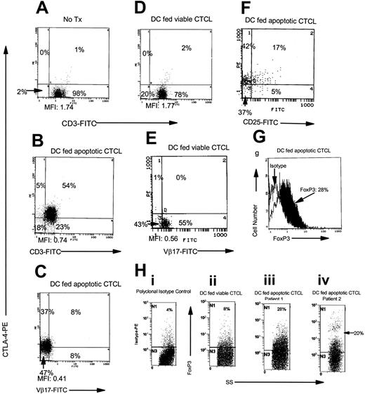 Figure 1. Induction of CTLA-4 expression in CTCL cells. (A) Nonloaded DC-stimulated fresh CTCL cells and membrane CD3/cytoplasmic CTLA-4 expression was measured. Treg-cell induction was monitored by measuring the coexpression of (B) membrane CD3/cytoplasmic CTLA-4 and (C) membrane Vβ17 (antibody to the variable region of the beta chain of the TCR that is clonotypically expressed on the tumor cells)/cytoplasmic CTLA-4. (D) DCs pulsed with viable CTCL cells (incubated with CD4 antibody) provided a control for tumor-loaded DCs by measuring membrane CD3/cytoplasmic CTLA-4 and (E) membrane Vβ17/cytoplasmic CTLA-4. (F) Induced Treg cells coexpressed membrane CD25/cytoplasmic CTLA-4. Results are reported as percentage of positive cells and mean fluorescence intensity (MFI). Results are representative of 10 separate experiments performed on cells isolated from cultures of 8 different CTCL patients. (G) CTCL cells were induced to express cytoplasmic FoxP3, compared with isotype-matched control (1-color histogram), by overnight incubation with DCs loaded with apoptotic tumor cells in. (H) Isotype control (donkey antigoat PE) staining in CTCL cells is compared (i) with CTCL cocultivated overnight with DCs exposed to viable CTCL cells (ii) and CTCL cells isolated from 2 patients and cultured with DCs that had ingested apoptotic tumor cells (iii and iv). Histograms demonstrate side scatter gating on the lymphocyte population compared with FoxP3 PE staining.