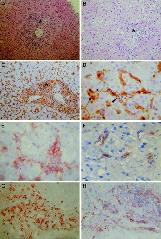 Figure 1. Routine and immunohistochemical stainings of liver biopsies. (A) Hematoxylin-eosin stain shows massive infiltration of portal tract (asterisk) and sinusoids by mononuclear cells. (B) Hematoxylin-eosin stain of specimen from patient D reveals a blank appearance of the portal tract. The numerous macrophages cannot be recognized. (C) CD68 stain shows numerous macrophages as large, irregularly shaped CD68+ cells, localized both in the portal tract (asterisk) and sinusoids. (D) Detail of CD68 stain shown in panel C shows active phagocytosis by CD68+ macrophages of lymphocytes (arrowhead), erythrocytes (short arrow), and polynuclear cells (long arrow). (E) TNF-α stain shows TNF-α production by macrophages, identified as large irregularly shaped cells in portal tracts and sinusoids. (F) IL-6 stain shows IL-6 production by macrophages, identified as large irregularly shaped cells in portal tracts and sinusoids. (G) CD8 stain shows numerous CD8+ lymphocytes as small, round CD8+ cells, with a small rim of cytoplasm. (H) IFN-γ stain shows IFN-γ production by lymphocytes, identified as small, round cells with a small rim of cytoplasm. The microscope was a Leitz Laborlux 5 (Wetzlar, Germany); objective lenses × 2.5, × 10, × 40, and × 100. The digital camera was a Nikon Coolpix 950, and image processing was done with Adobe Photoshop CS.