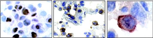 Figure 4. A section from patient 4. (Left) Nuclear staining for EBNA2. (Middle) Positive staining for IL-18Rα in a subset of immunoblastic cells. (Right) Highermagnification micrograph showing membrane staining for IL-18Rα.