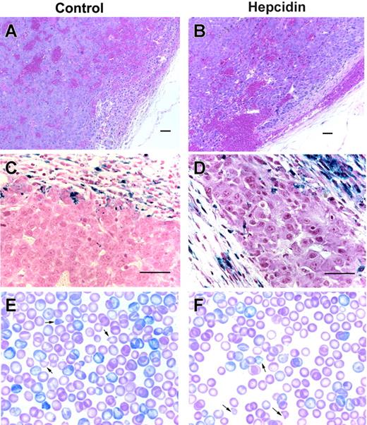 Figure 5. Tumor xenografts sections and peripheral blood smears. Hematoxylin and eosin low-power images of hepatoma xenografts expressing GFP (A) or hepcidin and GFP (B) show sheets of neoplastic hepatocytes, abnormal blood vessels, and areas of hemorrhage. Corresponding Perl Prussian blue-stained sections (C-D) demonstrate hemosiderin-laden macrophages in the fibrous capsule surrounding the tumors. Scale bars represent 50 μm. Panels E and F show Giemsa-stained blood smears from a pair of similarly severely anemic (Hgb level 68 vs 67 g/L) mice with hepatoma xenografts either not engineered or engineered to express hepcidin, respectively, on a high-iron diet. Arrows point to some of the many erythrocyte fragments.