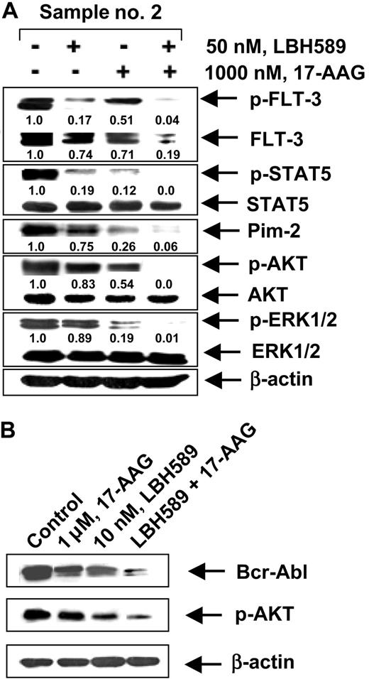 Figure 7. Effect of 17-AAG and/or LBH589 on pro-growth and pro-survival signaling proteins. Cotreatment with LBH589 and/or 17-AAG attenuates Bcr-Abl in primary CML-BC (B) and p-FLT-3 and FLT-3 in primary AML cells (A). Following treatment with 50 nM of LBH589 and/or 1000 nM 17-AAG for 24 hours, Western blot analyses of p-FLT-3, FLT-3, p-STAT5, STAT5, Pim-2, p-AKT, AKT, p-ERK1/2, and ERK 1/2 were performed on the cell lysates from sample no. 2. The levels of β-actin served as the loading control.