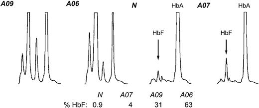 Figure 7. Hemoglobin HPLC. Lysates from erythroid cell cultures from healthy individual N, simple Corfu heterozygote A07, compound Corfu heterozygote A09, and Corfu homozygote A06 were quantitated via cation-exchange HPLC. The peaks for HbA and HbF are indicated. The percentage of HbF from total hemoglobin, % HbF, is also indicated for each individual.