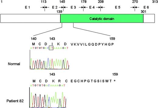 Figure 1. Representation of the normal UNG protein consisting of 313 amino acids and the putative truncated protein of 158 amino acids identified in patient 82. The deletion of 2 nucleotides (AT) in exon 2 (E2) causes frameshift at amino acid 143, resulting in a stop codon at position 159.