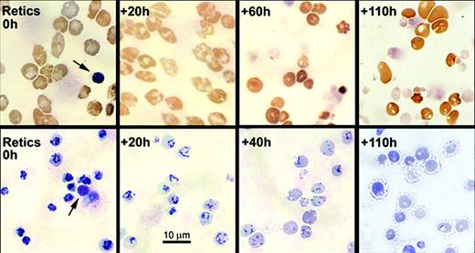 Figure 2. Morphological changes in light microscopy of cytospin preparations of cultured nascent reticulocytes. Aliquots of cultured nascent reticulocytes were harvested for cytospin preparations at the times shown. Upper row shows 3, 3′-dimethoxybenzidine staining, and lower row shows new methylene blue supravital staining for reticulin. For reference, each field of the 0-hour reticulocytes shows an extruded nucleus (arrows). Magnification, × 450.
