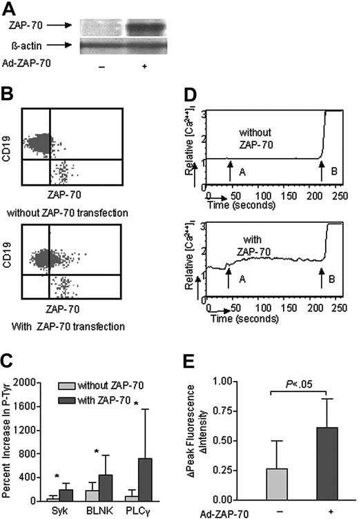 Figure 4. Transduction of ZAP-negative CLL B cells with Ad-ZAP70 enhanced p72Syk, BLNK, and PLCγ phosphorylation and calcium mobilization. (A, B) Intracellular ZAP-70 in ZAP-70– CLL B cells following transduction with a control adenovirus vector (–) or Ad-ZAP70 (+) by immunoblot analysis and flow cytometry. (C) IgM-induced phosphorylation of p72Syk, BLNK and PLCγ in ZAP-70– CLL B cells following transduction with a control adenovirus vector (light gray bars) or Ad-ZAP70 (dark gray bars). The bar size corresponds to the percent increase in phosphorylated proteins after anti-μ stimulation by CBA assay. *P < .01 between the cells transduced with a control adenovirus vector versus Ad-ZAP70. (D) IgM-induced calcium mobilization in ZAP-70– CLL B cells following transduction with a control adenovirus vector (–) or Ad-ZAP70 (+). The relative mean fluorescence intensity in intracellular calcium is plotted as a function of time: arrow A indicates IgM stimulation; arrow B, ionomycin stimulation. (E) IgM ligation–induced calcium fluorescence intensity increase in ZAP-70– CLL B cells following transduction with a control adenovirus vector (–) or Ad-ZAP70 (+). The bar size corresponds to the increase of fluorescence intensity value after anti-μ stimulation. + indicates CLL B cells transduced with Ad-ZAP70; –, CLL B cells transduced with control adenovirus vector. Error bars indicate mean ± SD.
